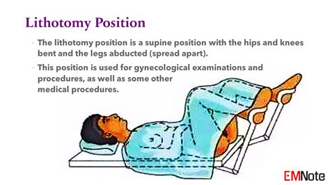 截刀臥位姿勢|截石位 lithotomy position